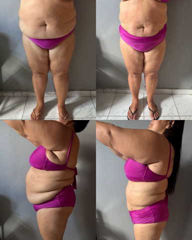 Antes e Depois do Dermodiet