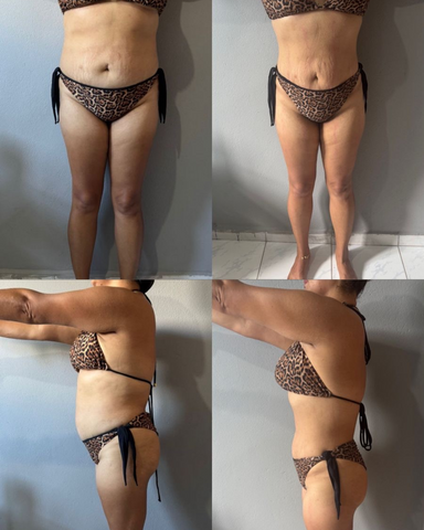 Antes e Depois do Dermodiet
